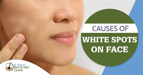 What are Causes of white spots on the face?