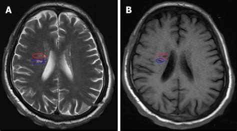 Malignant syphilis accompanied with neurosyphilis in a malnourished patient: A case report