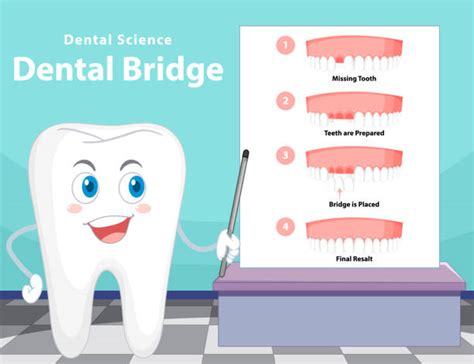 What is the procedure of a dental bridge? - Education Arenas