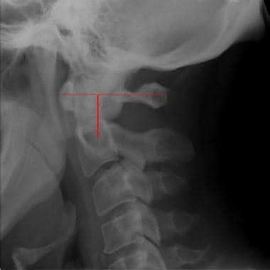 Rheumatoid Arthritis X Ray Neck