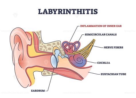 Labyrinthitis as inner ear infection and medical inflammation outline diagram – VectorMine