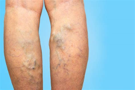 What to do About Bothersome, Bulging Leg Veins: Premier Vein & Vascular: Vascular and ...