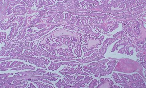 Primary apocrine carcinoma of the axilla in a male patient: a case report - Zahid - 2016 ...