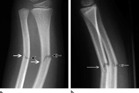 Paediatric fractures: distinctive features of the immature skeleton – Pedmore Medical