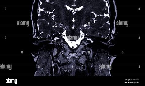 MRI scan of the internal auditory canal (IAC Stock Photo - Alamy