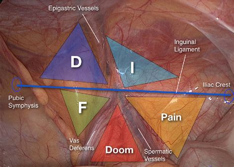 Figure 3 from SYSTEMIZATION OF LAPAROSCOPIC INGUINAL HERNIA REPAIR ...