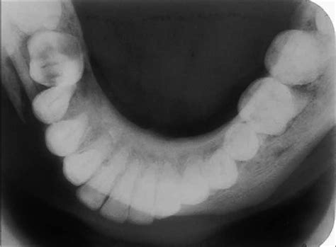 OCCLUSAL RADIOGRAPH 15 | Buyxraysonline