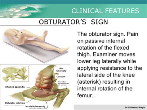 Psoas Sign In Appendicitis / The psoas sign, also known as cope's psoas test or obraztsova's ...