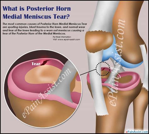 What is Posterior Horn Medial Meniscus Tear|Causes|Symptoms|Treatment|Recovery