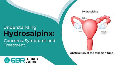 What is Hydrosalpinx and Causes of Hydrosalpinx,best fertility doctors near chennai, tamil nadu ...