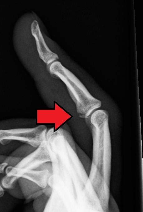 Avulsion fracture - Alchetron, The Free Social Encyclopedia