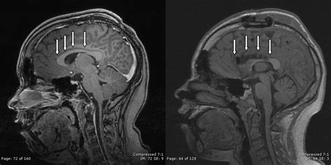 Corpus Callosotomy | St. Louis Children's Hospital