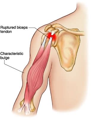 What is a Biceps Tendon Rupture and How is it Fixed?