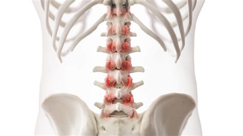 Arthritis Of The Spine - Symptoms and Treatments - Total Spine and Ortho