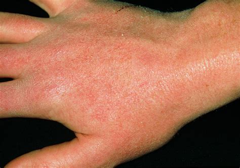 Dry Skin Reaction On Hand Due To Anti-acne Drug Photograph by Dr P. Marazzi/science Photo Library