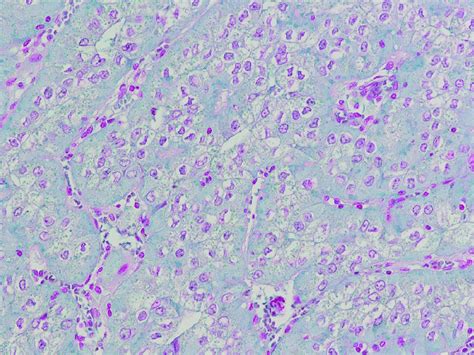 Hale's colloidal iron staining is focally and weakly positive (Case 2). | Download Scientific ...