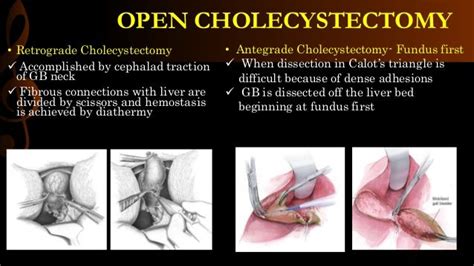 Open cholecystectomy/ operative surgery