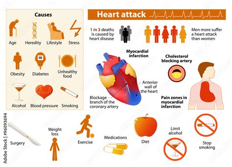 Heart attack infographic Stock Vector | Adobe Stock