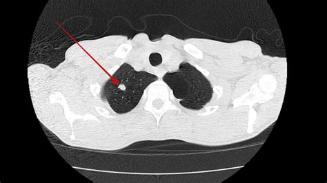 Cureus | Occult Non-small Cell Lung Cancer Presenting as Paraneoplastic Gastroparesis: A Case ...