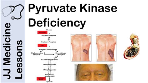 Pyruvate Kinase Deficiency | Symptoms, Pathophysiology, and Treatment - YouTube