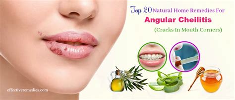 20 Home Remedies For Angular Cheilitis (Cracks In Mouth Corners)