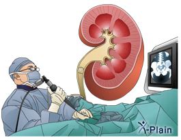 Ureteroscopy with Laser Lithotripsy