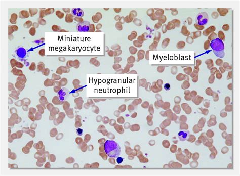 Macrocytosis: pitfalls in testing and summary of guidance | The BMJ