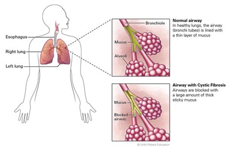 Cystic Fibrosis