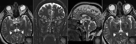 Radiology MRI: Idiopathic Intracranial Hypertension