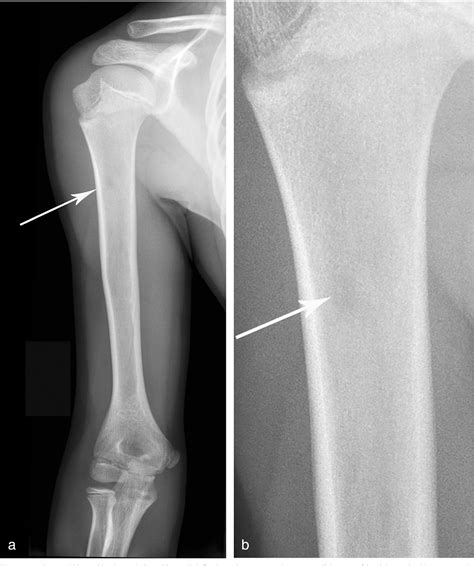 Irresti: Cortical Desmoid Knee Mri