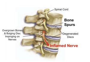 Bone Spurs - Causes? - Eddie O'Grady Physiotherapist