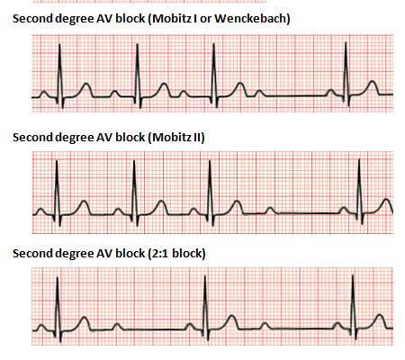 Heart Block: First Degree vs Second Degree (Type I and Type 2) vs Third Degree – ECG Findings ...