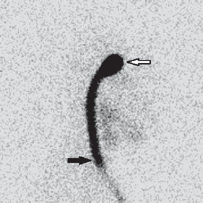 (PDF) Distal Ventriculoperitoneal Catheter Migration Revealed by Radionuclide Shuntogram