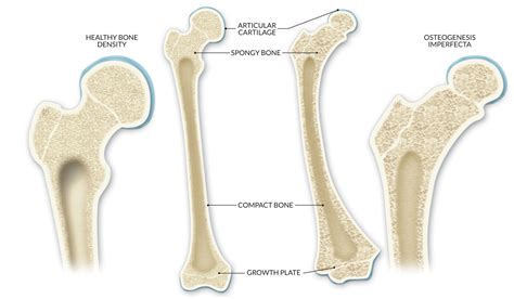 Understanding Osteogenesis Imperfecta: The Fragile Bone Disorder