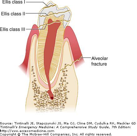 Ellis classification for fractures of teeth | Emergency medicine, Dental clinic, Physician assistant