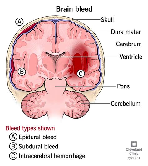 Brain Bleed (Intracranial Hemorrhage): Causes & Symptoms