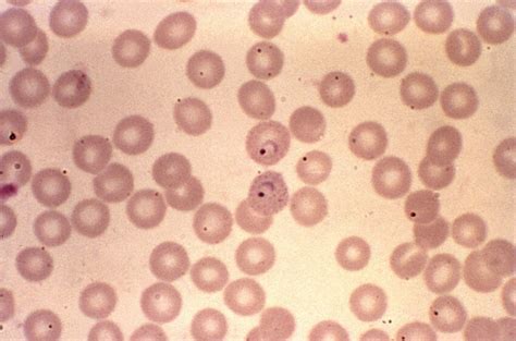 Free picture: plasmodium vivax, rings, large, chromatin, dots, show, amoeboid, cytoplasm, develo