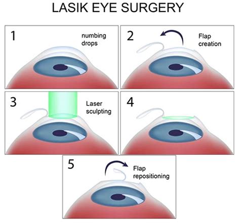 LASIK eye surgery for astigmatism | What you need to know