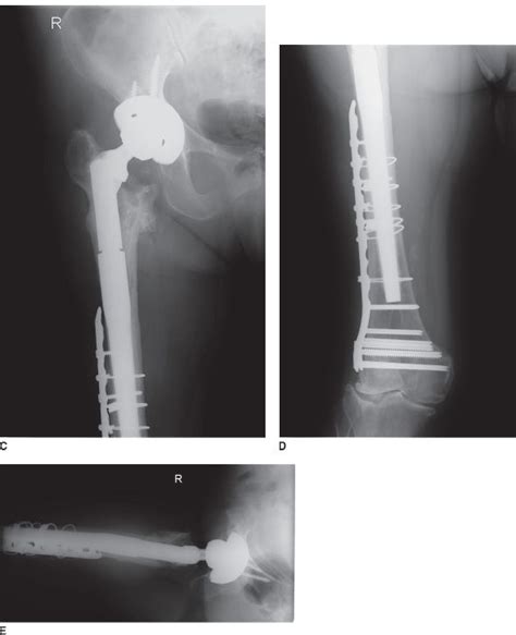 Prevention and Management of Complications Following Total Hip ...