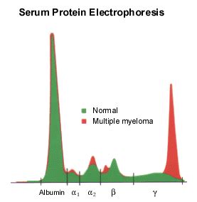 A monoclonal immunoglobulin is present – now what? | Pathology Student