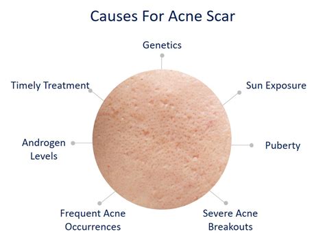 Why Do Some People Have Acne Scars While Others Don’t? | Dream Plastic ...