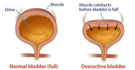 Living With An Overactive Bladder | Things Health