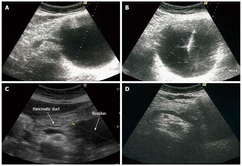 Minimally invasive treatment of pancreatic pseudocysts