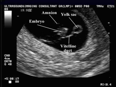 Vitelline Duct Ultrasound