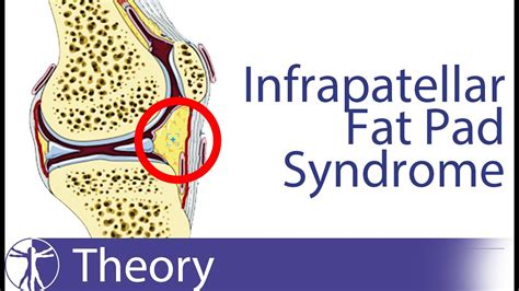 Suprapatellar Fat Pad Impingement Syndrome - Quotes Viral Update