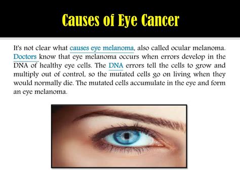 PPT - Eye Cancer (Eye Melanoma): Symptoms, Causes, Diagnosis and Treatment. PowerPoint ...