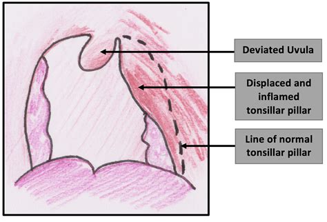 Peritonsillar abscess - Management - TeachMePaediatrics