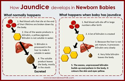 Jaundice in breast-fed babies - Love and Breast Milk