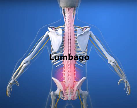 Le lumbago - Santé - RedoxSanté – Redox