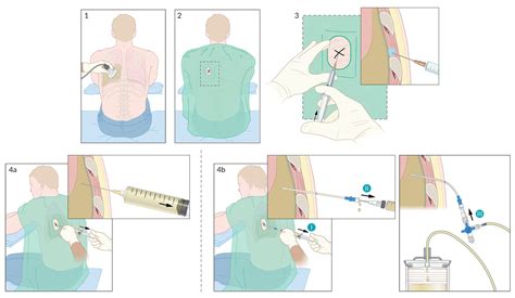 Thoracentesis Procedure Steps